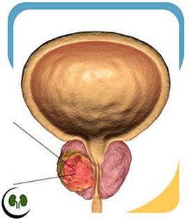 Prostate Cancer Doctor in Smithfield, NC