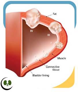 Bladder Cancer in Smithfield, NC