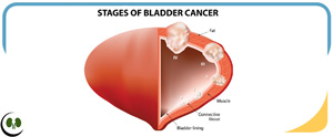 Bladder Cancer Treatment Centers Near Me Smithfield, NC Bladder Cancer Treatment Centers Near Me Smithfield, NC