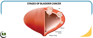 Bladder Cancer Treatment Centers Near Me Smithfield, NC